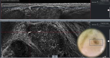 Line-Field OCT (LC-OCT)
